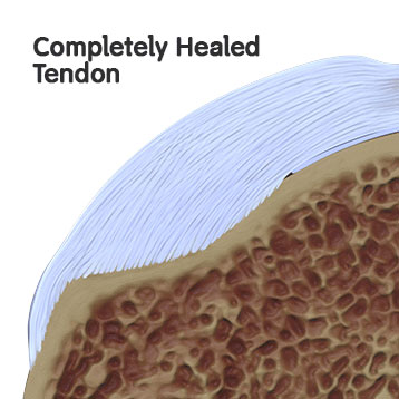 Completely Healed Tendon on Rotator Cuff Surgery