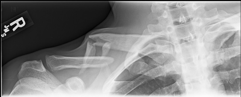 Clavicle Fracture X-Ray From Orthopedic Specialist
