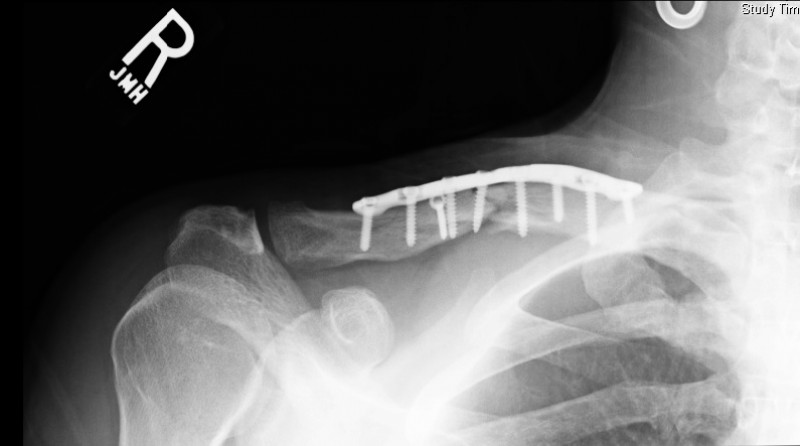 Orthopedic Specialist Clavicle Fracture X-Ray